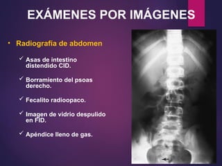 EXÁMENES POR IMÁGENES
• Radiografía de abdomen
 Asas de intestino
distendido CID.
 Borramiento del psoas
derecho.
 Fecalito radioopaco.
 Imagen de vidrio despulido
en FID.
 Apéndice lleno de gas.
 