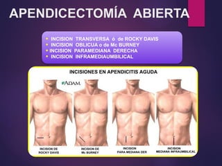 APENDICECTOMÍA ABIERTA
• INCISION TRANSVERSA ó de ROCKY DAVIS
• INCISION OBLICUA o de Mc BURNEY
• INCISION PARAMEDIANA DERECHA
• INCISION INFRAMEDIAUMBILICAL
 
