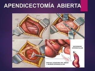 APENDICECTOMÍA ABIERTA
 