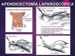 APENDICECTOMÍA LAPAROSCÓPICA
 