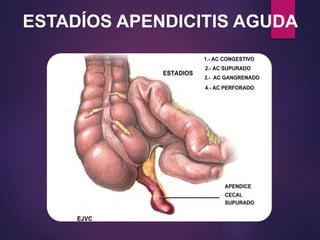 ESTADÍOS APENDICITIS AGUDA
 