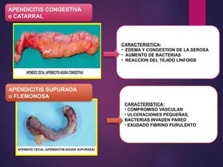 APENDICITIS CONGESTIVA
o CATARRAL
CARACTERISTICA:
• EDEMA Y CONGESTION DE LA SEROSA
• AUMENTO DE BACTERIAS
• REACCION DEL TEJIDO LINFOIDE
APENDICITIS SUPURADA
o FLEMONOSA
CARACTERISTICA:
• COMPROMISO VASCULAR
• ULCERACIONES PEQUEÑAS,
BACTERIAS INVADEN PARED
• EXUDADO FIBRINO PURULENTO
 