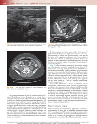 1126 PART III  Medicine and Surgery  |  SECTION Five  Gastrointestinal System
To this end, there have been recent studies of low-dose CT
protocols for the diagnosis of appendicitis. These low-dose pro-
tocols decrease the average dose to approximately 2 mSv, with no
detriment in the negative appendectomy rate. However, there is
less diagnostic certainty by radiologists about the diagnosis of
appendicitis with these studies. These are relatively new protocols
that show promise but require more studies before they can be
universally adopted.17,18
Table 83.4 lists CT findings diagnostic of appendicitis. In some
cases, the appendix cannot be visualized. In these cases, if CT
demonstrates no findings of inflammation in the RLQ, it has been
found that appendicitis is unlikely. However, patients with low
amounts of intra-abdominal body fat may not display secondary
signs of inflammation; consequently, these patients may lack this
important marker of appendicitis on CT imaging, leading to false-
negative study results. The term tip appendicitis refers to obstruc-
tion and inflammation limited to the distal tip of the appendix
and is a subtle finding on CT that is a common cause of false-
negative interpretation.19
To assess for appendicitis, CT should be performed with IV
contrast only. Enteric contrast of any type, oral or rectal, contrib-
utes little to the assessment of appendicitis. In addition, studies
have demonstrated that non–contrast-enhanced CT has accept-
able accuracy in diagnosing appendicitis. Furthermore, according
to the American College of Radiology’s appropriateness criteria
for imaging suspected appendicitis, CT imaging with or without
IV contrast are acceptable imaging modalities, with the use of
enteric contrast being deferred to institutional preference. There-
fore, if there are contraindications to IV contrast, there should be
little hesitation to move forward with non–contrast-enhanced CT
for the evaluation of appendicitis.17
Magnetic Resonance Imaging
When considering the evaluation for appendicitis, current evi-
dence supports the use of MRI for assessment in pregnant females
if US is nondiagnostic. MRI has the advantage of not using ion-
izing radiation and is not operator-dependent. However, its use is
limited by its increased cost, increased time required to acquire
images,limited availability,and need for the radiologist or surgeon
The greatest disadvantage of CT is the ionizing radiation. A CT
scan of the abdomen exposes the patient to an average dose of
ionizing radiation equivalent to 8 examination 10 mSv. To put this
in perspective, the average ionizing radiation dose associated with
an abdominal x-ray is 0.7 mSv, and the average dose associated
with coronary angioplasty is 15 mSv. An abdominal CT carries an
excess risk of fatal cancer of 1 in 2000, a value that is even greater
in children. However, this value must be tempered by the fact that
the general population has a lifetime risk of being diagnosed with
cancer of 1 in 3. The risk of radiation increases conversely with
age, with children and fetuses having the greatest risk of adverse
outcomes of radiation due to their smaller body habitus, more
rapidly developing cells, and increased incubation time for genetic
mutations to manifest.
Fig. 83.5.  CT scan with typical findings of acute appendicitis. thick
arrow, thin arrows, dashed line arrow.
Fig. 83.6.  Oral contrast CT scan showing discrete abscess from appen-
diceal perforation, with periappendiceal fat streaking. (Courtesy Jefferson
Radiology, Avon, CT.)
Fat stranding
Discrete abscess
from perforated
appendix
Fig. 83.4.  Graded compression ultrasound scan demonstrating a dilated
noncompressible appendix (thin arrow) representing appendicitis.
Descargado para Francisco Medina Anderson (fz.medina@hotmail.com) en Organización de Estados Iberoamericanos - Remote Access de ClinicalKey.es por Elsevier en julio 07, 2017.
Para uso personal exclusivamente. No se permiten otros usos sin autorización. Copyright ©2017. Elsevier Inc. Todos los derechos reservados.
 