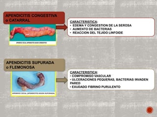 APENDICITIS CONGESTIVA
o CATARRAL CARACTERISTICA:
• EDEMA Y CONGESTION DE LA SEROSA
• AUMENTO DE BACTERIAS
• REACCION DEL TEJIDO LINFOIDE
APENDICITIS SUPURADA
o FLEMONOSA
CARACTERISTICA:
• COMPROMISO VASCULAR
• ULCERACIONES PEQUEÑAS, BACTERIAS INVADEN
PARED
• EXUDADO FIBRINO PURULENTO
 