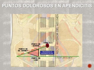 PUNTOS DOLOROSOS EN APENDICITIS
 