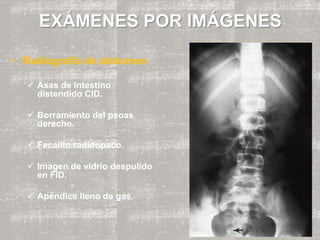 EXÁMENES POR IMÁGENES
• Radiografía de abdomen
 Asas de intestino
distendido CID.
 Borramiento del psoas
derecho.
 Fecalito radioopaco.
 Imagen de vidrio despulido
en FID.
 Apéndice lleno de gas.
 