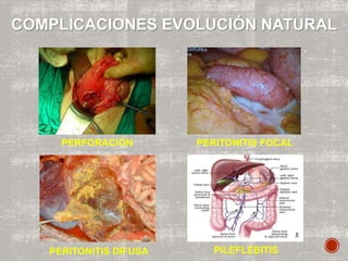 COMPLICACIONES EVOLUCIÓN NATURAL
PERFORACIÓN PERITONITIS FOCAL
PERITONITIS DIFUSA PILEFLEBITIS
 