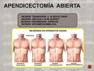 • INCISION TRANSVERSA ó de ROCKY DAVIS
• INCISION OBLICUA o de Mc BURNEY
• INCISION PARAMEDIANA DERECHA
• INCISION INFRAMEDIAUMBILICAL
 