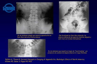 Rx de abdomen simple que muestra apendicolito en
fosa ilíaca derecha (flecha blanca).
Ileo localizado en fosa ilíaca derecha. Se
observa dilatación de asas de intestino delgado a
este nivel con niveles hidroaéreos.
Rx de abdomen que muestra el signo de “fecal loading” con
presencia de acúmulo de deposiciones en el ciego (flechas).
Rybkin A, Thoeni R. Current Concepts in Imaging of Appendicitis. Radiologic Clinics of North America,
Volume 45, Issue 3, Pages 411-422
 