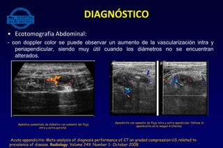 • Ecotomografia Abdominal:
- con doppler color se puede observar un aumento de la vascularización intra y
periapendicular, siendo muy útil cuando los diámetros no se encuentran
alterados.
DIAGNÓSTICO
Acute appendicitis: Meta-analysis of diagnosis performance of CT an graded compression US related to
prevalence of disease. Radiology: Volume 249: Number 1- October 2008
Apéndice aumentada de diámetro con aumento del flujo
intra y extra parietal.
Apendicitis con aumento de flujo intra y extra apendicular. Nótese el
apendicolito en la imagen A (flecha)
 