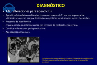 • TAC: alteraciones para apendicitis:
• Apéndice distendido con diámetro transverso mayor a 6-7 mm, por lo general de
ubicación retrocecal, siempre teniendo en cuenta las localizaciones menos frecuentes.
• Presencia de apendicolito.
• Engrosamiento parietal que realza con el medio de contraste endovenoso.
• Cambios inflamatorios periapendiculares.
• Adenopatías pericecales.
DIAGNÓSTICO
Reconstrucción coronal de apendicitis distal (flechs blancas) conapendicolito
(flecha transparente). Puntas de flecha muestran tercio proximal del
apendice)
 