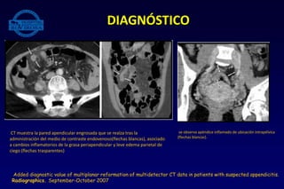 DIAGNÓSTICO
CT muestra la pared apendicular engrosada que se realza tras la
administración del medio de contraste endovenoso(flechas blancas), asociado
a cambios inflamatorios de la grasa periapendicular y leve edema parietal de
ciego (flechas trasparentes)
se observa apéndice inflamado de ubicación intrapélvica
(flechas blancas).
Added diagnostic value of multiplanar reformation of multidetector CT data in patients with suspected appendicitis.
Radiographics. September-October 2007
 