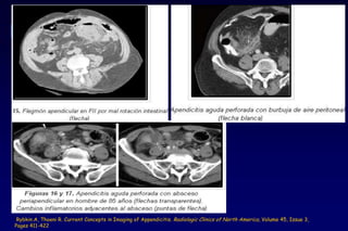 Rybkin A, Thoeni R. Current Concepts in Imaging of Appendicitis. Radiologic Clinics of North America, Volume 45, Issue 3,
Pages 411-422
 