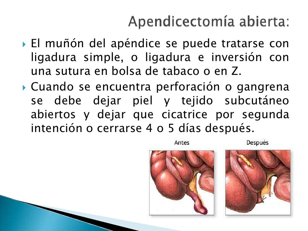 Apendicitis aguda