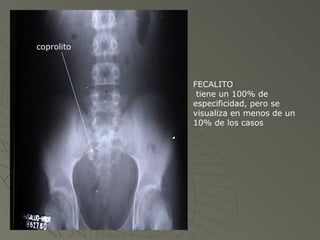 coprolito FECALITO tiene un 100% de especificidad, pero se visualiza en menos de un 10% de los casos 