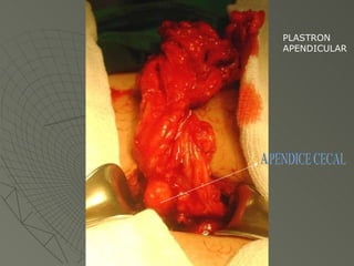 PLASTRON  APENDICULAR APENDICE CECAL 