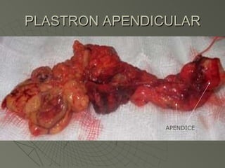 PLASTRON APENDICULAR APENDICE 