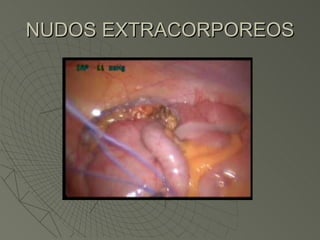 NUDOS EXTRACORPOREOS 
