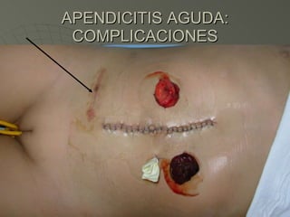 APENDICITIS AGUDA: COMPLICACIONES 