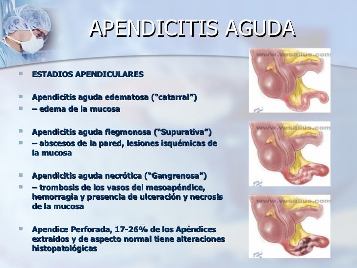 Apendicitis aguda