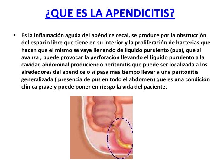 Apendicitis aguda