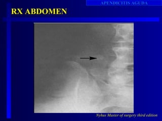 APENDICITIS AGUDA

RX ABDOMEN




             Nyhus Master of surgery third edition
 