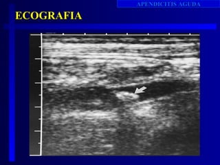 APENDICITIS AGUDA

ECOGRAFIA
 