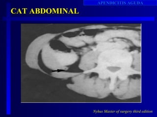 APENDICITIS AGUDA

CAT ABDOMINAL




                Nyhus Master of surgery third edition
 