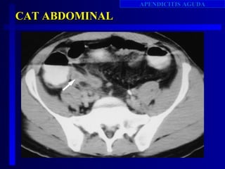 APENDICITIS AGUDA

CAT ABDOMINAL
 
