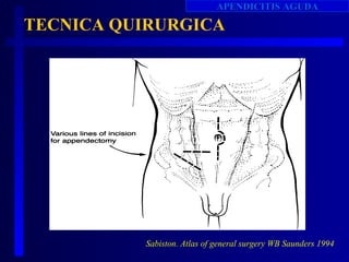APENDICITIS AGUDA

TECNICA QUIRURGICA




          Sabiston. Atlas of general surgery WB Saunders 1994
 