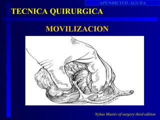 APENDICITIS AGUDA

TECNICA QUIRURGICA

      MOVILIZACION




                Nyhus Master of surgery third edition
 