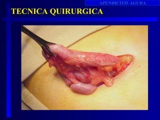 APENDICITIS AGUDA

TECNICA QUIRURGICA
 