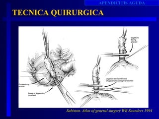 APENDICITIS AGUDA

TECNICA QUIRURGICA




          Sabiston. Atlas of general surgery WB Saunders 1994
 