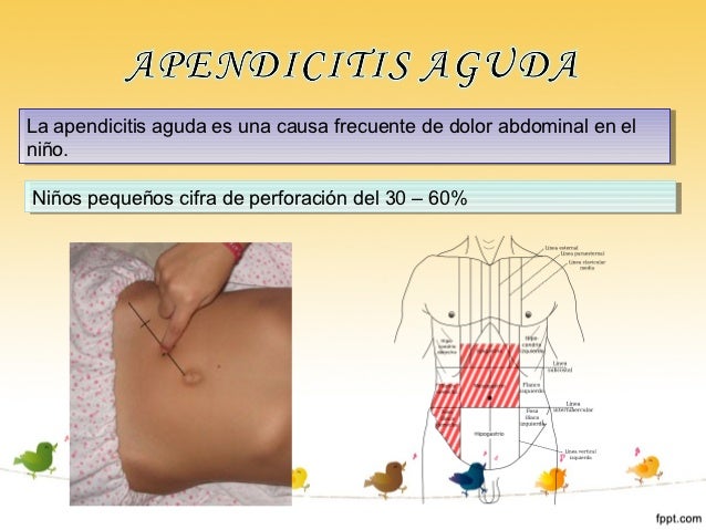 Apendicitis aguda