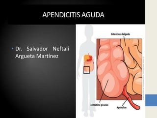 APENDICITIS AGUDA



• Dr. Salvador Neftalí
  Argueta Martínez
 