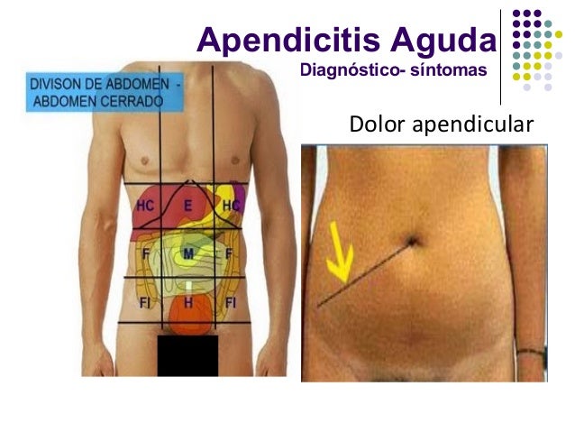 Apendicitis aguda