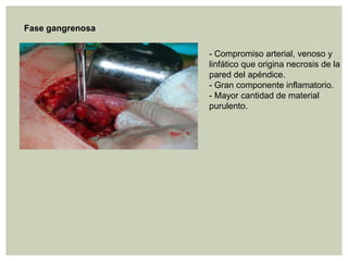 Fase gangrenosa
- Compromiso arterial, venoso y
linfático que origina necrosis de la
pared del apéndice.
- Gran componente inflamatorio.
- Mayor cantidad de material
purulento.

 