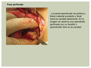 Fase perforada

- La pared apendicular se perfora y
libera material purulento y fecal
hacia la cavidad abdominal. En la
imagen se observa una apendicitis
perforada con un fecalito o
apendicolito libre en la cavidad.

 