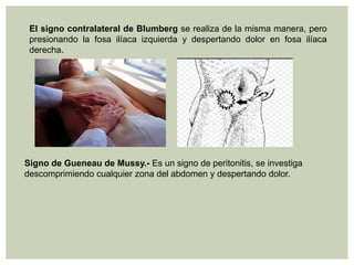El signo contralateral de Blumberg se realiza de la misma manera, pero
presionando la fosa ilíaca izquierda y despertando dolor en fosa ilíaca
derecha.

Signo de Gueneau de Mussy.- Es un signo de peritonitis, se investiga
descomprimiendo cualquier zona del abdomen y despertando dolor.

 