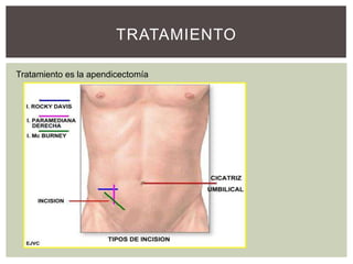 TRATAMIENTO
Tratamiento es la apendicectomía

 