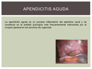 APENDICITIS AGUDA
La apendicitis aguda es un proceso inflamatorio del apéndice cecal y se
constituye en la entidad quirúrgica más frecuentemente intervenida por el
cirujano general en los servicios de urgencias

 
