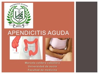 APENDICITIS AGUDA

Marcela caldera caballero
Universidad de sucre
Facultad de medicina

 