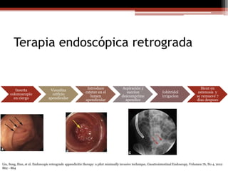 Apendicitis aguda | PPT