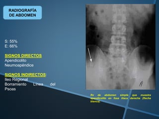 RADIOGRAFÍA
DE ABDOMEN
S: 55%
E: 66%
SIGNOS DIRECTOS
Apendicolito
Neumoapéndice
SIGNOS INDIRECTOS:
Ileo Regional
Borramiento Línea del
Psoas
Rx de abdomen simple que muestra
apendicolito en fosa ilíaca derecha (flecha
blanca).
 