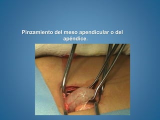 Pinzamiento del meso apendicular o del
apéndice.
 