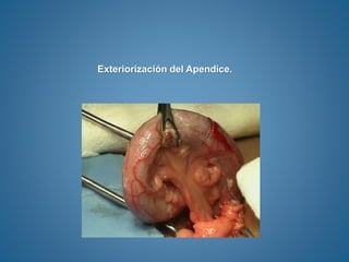 Exteriorización del Apendice.
 
