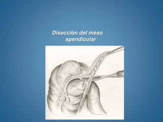 Disección del meso
apendicular
 