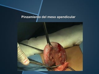 Pinzamiento del meso apendicular
 