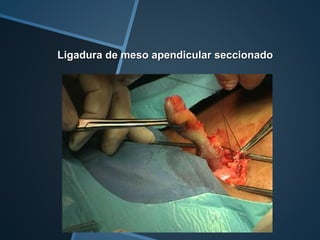 Ligadura de meso apendicular seccionado
 