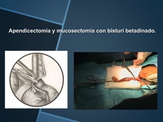 Apendicectomia y mucosectomia con bisturi betadinado.
 